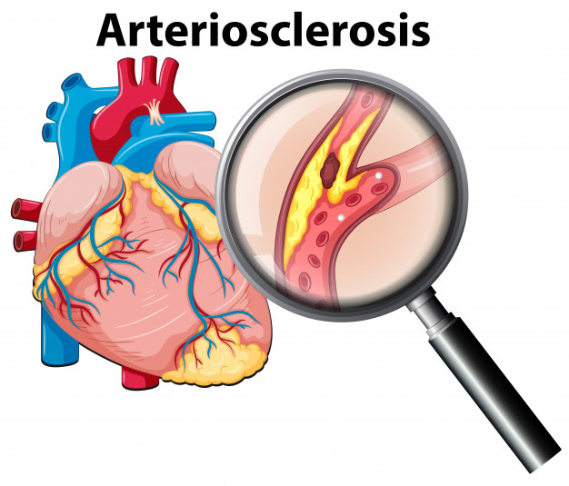 Ateroscleroza